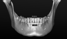 Figure 2. Mandibular intercanine dental and alveolar widths.