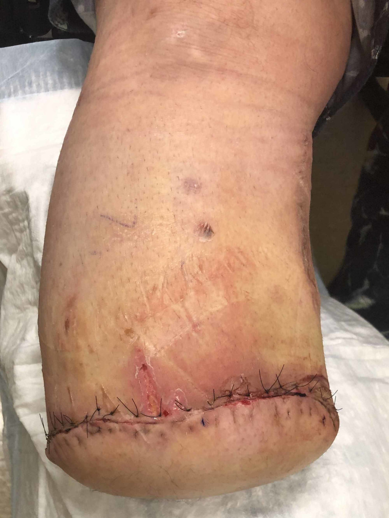 A Novel Use Of Next Generation Closed Incision Negative Pressure Wound a-novel-use-of-next-generation-closed-incision-negative-pressure-wound