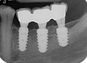 Evaluation of complication rates and vertical bone gain after guided ...