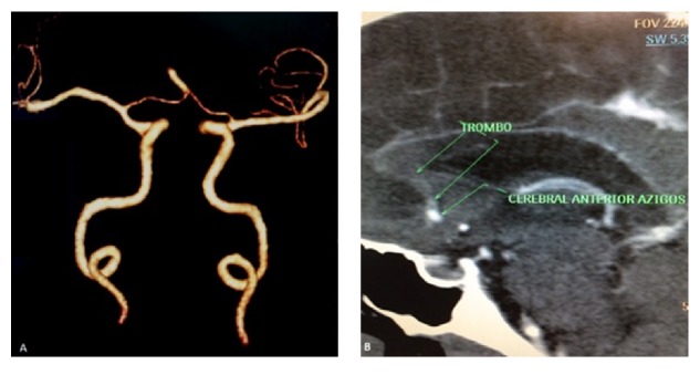 Thrombosis of the Azygos Anterior Cerebral Artery - PMC