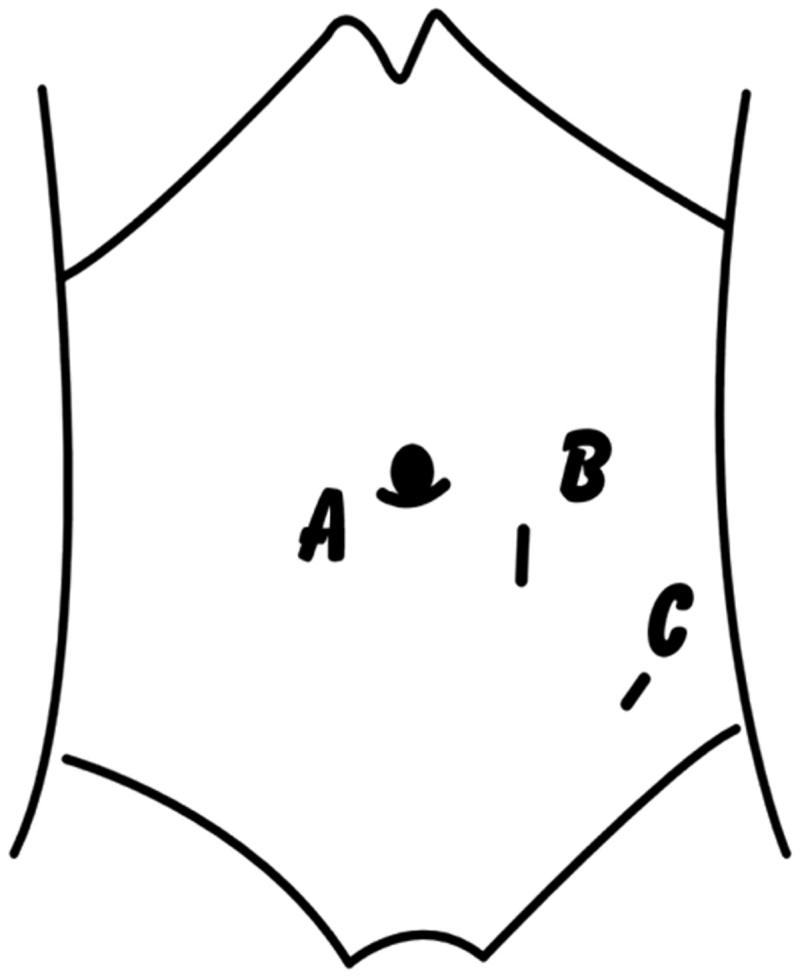 Prophylactic laparoscopic omentopexy: a new technique for peritoneal ...