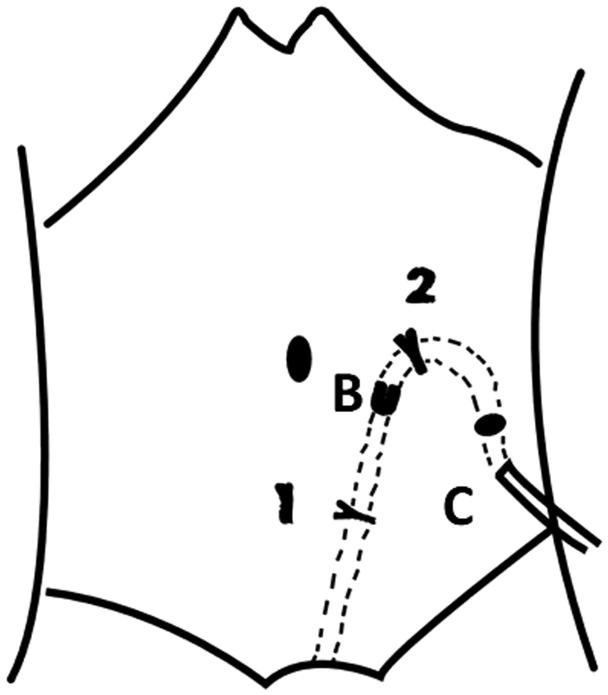 Prophylactic laparoscopic omentopexy: a new technique for peritoneal ...