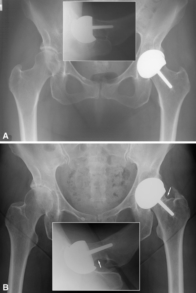 Does Femoral Neck To Cup Impingement Affect Metal Ion Levels In Hip 