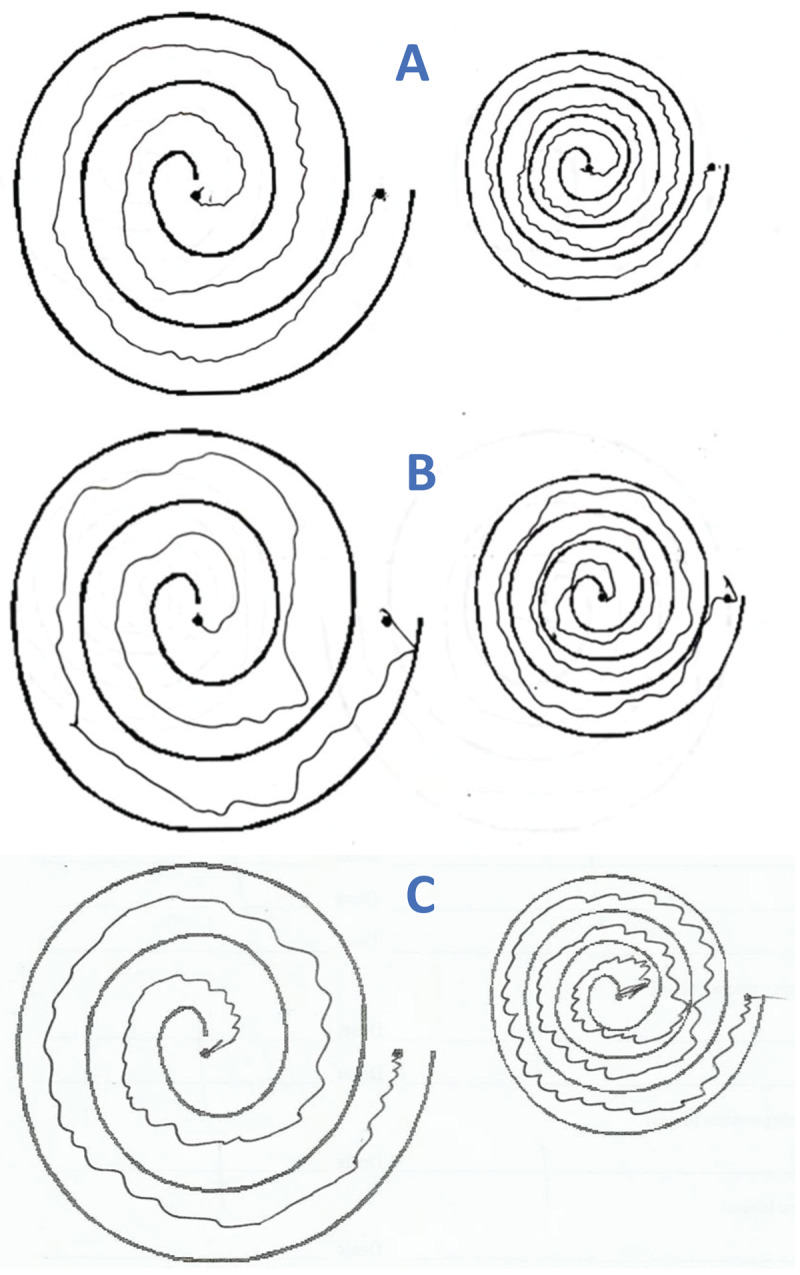 Examples of tremor in Archimedes spirals in two patients with Guillain-Barré, tremor has a jerky component without axes (A and B). Patient with essential tremor shows a regular tremor with axes (C)