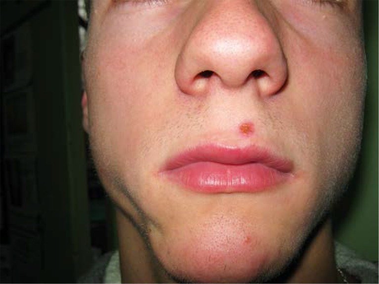 Acquired facial lipoatrophy pathogenesis and therapeutic options pmc