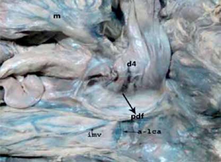 Clinical importance of duodenal recesses with special reference to ...