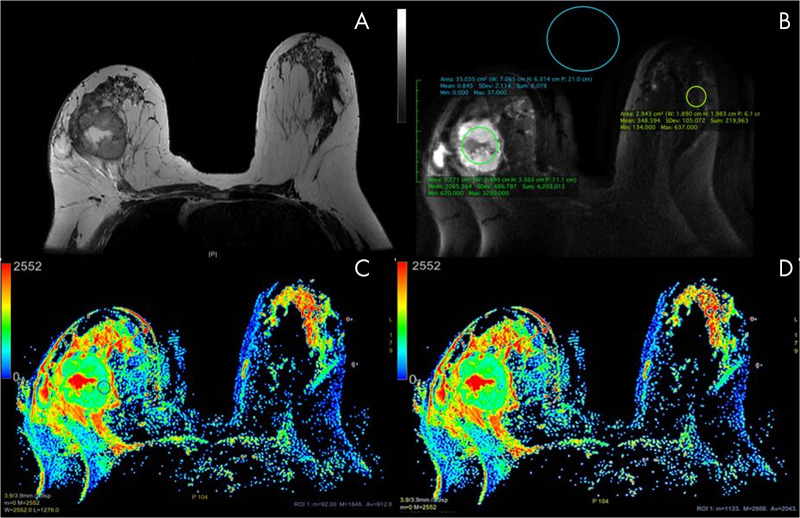 Axial images in a 59-year-old woman with a 50-mm invasive ductal carcinoma in the right breast. A, T2-weighted image without fat saturation shows a necrotic mass in the right breast and a normal contralateral breast. B, Multiplexed sensitivity-encoding (MUSE) diffusion-weighted image (b value, 800 sec/mm2) in the same slice as A depicting region of interest (ROI) positioning for quality parameters. C, D, Apparent diffusion coefficient (ADC) color maps derived from multishot MUSE diffusion-weighted imaging shows ROI placement. Note the ROI placement within the “darkest” part of the solid component of this necrotic mass in, C. The ROI of the healthy fibroglandular tissue is delineated in, D. The color bar in, C, and, D, indicates the ADC value range in × 10−6 mm2/sec. ADC values obtained from the ROI in, B: mean, 912.8 × 10−6 mm2/sec; minimum, 92 × 10−6 mm2/sec; maximum, 1846 × 10−6 mm2/sec; ROI area, 59.37 mm2. The ROI values in, C: mean, 2043 × 10−6 mm2/sec; minimum, 1133 × 10−6 mm2/sec; maximum, 2868 × 10−6 mm2/sec; ROI area, 52.5 mm2.