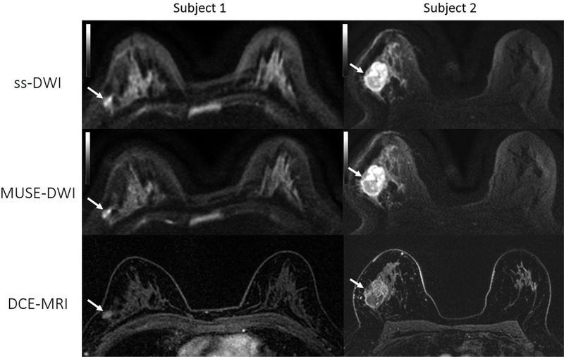 Axial images from two patients with biopsy-proven invasive ductal carcinoma. Left: Patient 1, a 36-year-old woman with a 9-mm mass in the upper outer quadrant of the right breast (arrow). Right: Patient 2, a 57-year-old woman with a 36-mm necrotic mass in the right upper breast (arrow). Both readers assigned category 1 (better overall image quality with multishot multiplexed sensitivity-encoding diffusion-weighted imaging [MUSE-DWI] than with single-shot DWI [ss-DWI]) for overall image quality since MUSE DWI (b value, 800 sec/mm2) showed better lesion delineation compared with single-shot DWI (b value, 800 sec/mm2). Note also that artifact seen with single-shot DWI is partially corrected at MUSE DWI in patient 1.