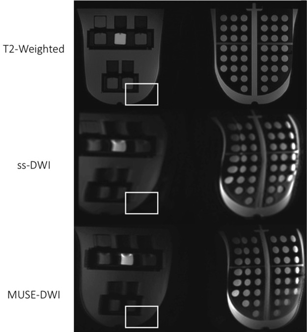 Axial images from phantom testing. T2-weighted image (top panel), single-shot diffusion-weighted image (ss-DWI) (middle panel), and high-spatial-resolution multiplexed sensitivity-encoding diffusion weighted image (MUSE-DWI) with protocol D (bottom panel) are shown. The region of interest is placed to show the presence of geometric distortion artifact on diffusion-weighted images, which is partially corrected with MUSE DWI.