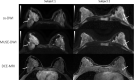 Axial images from two patients with benign lesions. Left: Patient 1, a 43-year-old woman with a 5-mm enhancing focus in the outer right breast in which stability was verified after 2-year follow-up (arrow). Right: Patient 2, a 47-year-old woman with an enhancing 7-mm nodule in the lower inner left quadrant (arrow). Biopsy results revealed fibroadenoma. Multiplexed sensitivity-encoding diffusion-weighted imaging (MUSE-DWI) yielded a sharper delineation of the breast parenchyma, and lesion contours appear to be more defined than in single-shot DWI (b value, 800 sec/mm2) (ss-DWI). These two examples were categorized as 1 (better overall image quality with MUSE DWI than with single-shot DWI) by both readers. DCE-MRI = dynamic contrast-enhanced MRI.