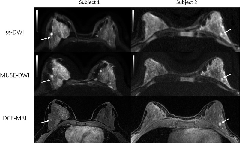 Axial images from two patients with benign lesions. Left: Patient 1, a 43-year-old woman with a 5-mm enhancing focus in the outer right breast in which stability was verified after 2-year follow-up (arrow). Right: Patient 2, a 47-year-old woman with an enhancing 7-mm nodule in the lower inner left quadrant (arrow). Biopsy results revealed fibroadenoma. Multiplexed sensitivity-encoding diffusion-weighted imaging (MUSE-DWI) yielded a sharper delineation of the breast parenchyma, and lesion contours appear to be more defined than in single-shot DWI (b value, 800 sec/mm2) (ss-DWI). These two examples were categorized as 1 (better overall image quality with MUSE DWI than with single-shot DWI) by both readers. DCE-MRI = dynamic contrast-enhanced MRI.