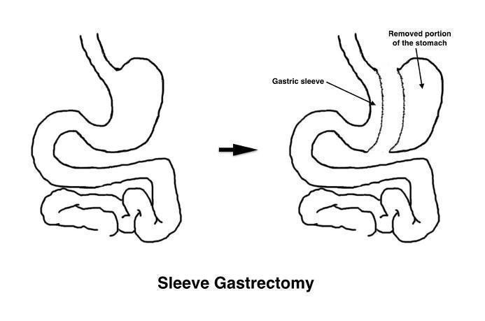 Staple line reinforcement for adults undergoing bariatric surgery with ...