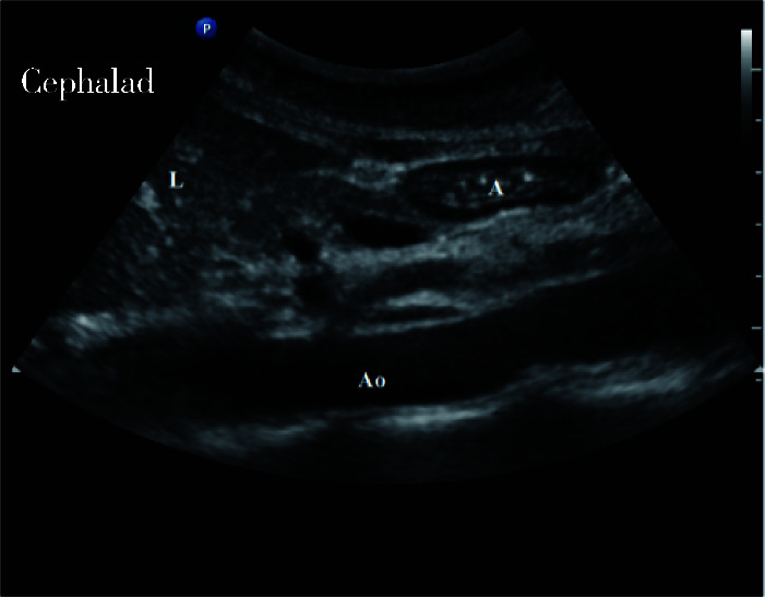 A, antrum; L, liver; Ao, aorta.