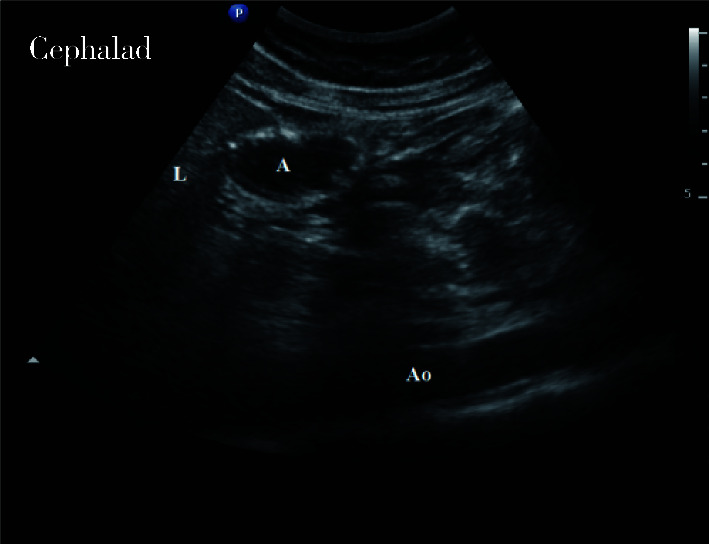 A, antrum; L, liver; Ao, aorta.