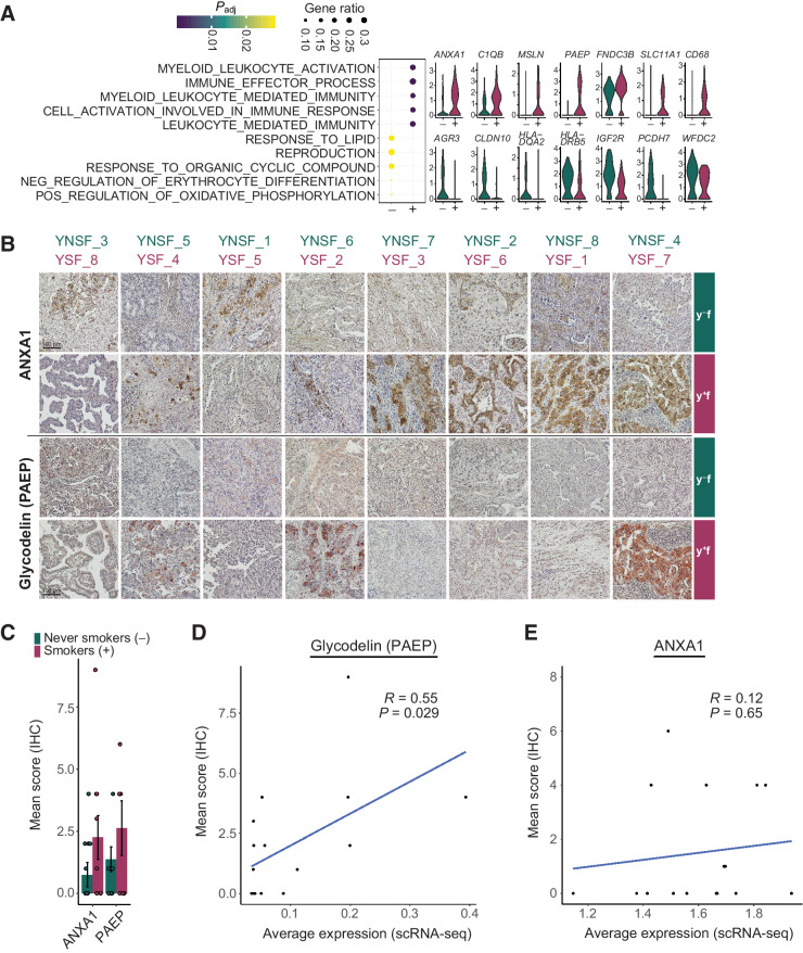 Figure 4. Immune modulating cell population in smokers and never smokers. Cells from young female patients in cluster Imm_1 were assessed for gene expression differences by smoking habit. A, Dot plot indicates enriched GO terms in Imm_1 cells from smokers (+) and never smokers (-). Dot sizes indicate the ratio of member genes present in the gene set that were detected in each population. Colors represent p-values (hypergeometric test after Benjamini–Hochberg correction). Violin plots depict representative genes with significantly different expression levels between never smokers (green) and smokers (red). B, IHC staining of ANXA1 and glycodelin (PAEP) in tumor cryosections from samples of young female smokers and never smokers. For each patient, one representative staining is shown. C, Quantification of IHC staining. Scoring was performed using five randomly selected tumor sections based on a combination of staining intensities and the number of positive cells; displayed are the mean ± s.e.m. D and E, Correlation of protein expression determined by quantitative scoring of immunohistochemistry staining and average gene expression across all tumor cells for Glycodelin (PAEP; D) and ANXA1 (E). Correlation visualized by a linear model and coefficient calculated using Pearson correlation.