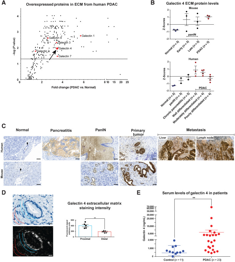 Figure 1. High levels of galectin 4 in pancreatic tumors and in the circulation of patients with pancreatic cancer. A, Volcano plot illustrating fold-change in extracellular expression of proteins detected from quantitative mass spectrometry performed on purified ECM from human PDAC tumors and normal pancreatic tissue (data from; ref. 22). Detected members of the galectin family of proteins in red. Arrow denotes galectin 4. Dotted horizontal line indicate significance level P = 0.05 (n = 5 tumors, n = 2 normal pancreatic tissue). B, Mass spectrometry Z scores for galectin 4 (data from; ref. 22) in mouse and human tissue from normal pancreas, PanIN, chronic pancreatitis, and tumor samples (subcategorized by early- and late-stage for mouse samples). Error bars indicate mean±SEM of Z-scores. C, Representative IHC staining of galectin 4 in murine and human normal pancreatic tissue, human pancreatitis, murine and human PanIN precursor lesions, KPC-derived murine cancer and well-differentiated human PDAC, and human liver and lymph node metastases. Arrows denote normal pancreatic ducts. 5 samples from each tissue condition were stained; scale bar, 50 μm. D, PDAC tumors counterstained with HTX (top left) and labeled with UCNPs (bottom left) on the same section. Semiquantitative analysis of gal 4 signal intensity in areas proximal to or distal from the epithelial cells (right). The UCNP emission was quantified in areas proximal to epithelial cells (blue dotted lines represent the area where the luminescent signal was quantified) or distal from tumors (red dotted lines represent the area where the luminescent signal was quantified) in 5 tumors; scale bar, 20 μm. E, ELISAs to detect serum galectin 4 protein in patients with PDAC (red) and aged-matched controls (blue). Significance calculated using the Mann–Whitney test (P = 0.0012). Error bars show mean±SEM.