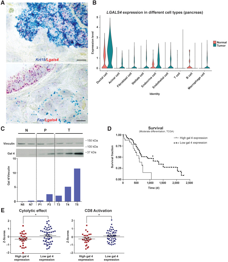 Figure 2. Galectin 4 is a cancer cell–derived marker of disease progression and prognosis in pancreatic cancer, with an association to reduced immune activity. A, Representative ISH images of cytokeratin 18 (Krt18, blue, top image) and fibroblast activation protein alpha (Fap, blue, the bottom image), together with gal 4 (Lgals4, in red), in mouse model of PDAC tumor tissue. 4 tumors analyzed in total; scale bar, 10 μm. B, Violin plot of single-cell RNA-sequencing data from Peng et al. (40) showing LGALS4 expression in cell types from human PDAC tumors. C, Western blot and quantification (semiquantitative) of gal 4 protein in normal murine ductal organoid (N, two different cell lines), PanIN organoid (P, two different cell lines), and tumor organoid (T, three different cell lines) cell lines. Vinculin was used as loading control. D, Kaplan–Meier survival curve adapted from the TCGA data set (26), with patients grouped into high (n = 26) and low (n = 49) gal 4 mRNA expression (groups defined in Materials and Methods) and relationship to survival in patients with PDAC with moderately differentiated tumors. *, Significance (P = 0.0254) calculated using the Mantel–Cox test. E, Z-score comparison of high (n = 26) and low (n = 49) gal 4-expressing tumors within the group of moderately differentiated PDAC tumors in the TCGA data set. Genes associated with cytolytic effect of immune cells analyzed in the left graph (P = 0.036), and CD8 activation scores analyzed in the right graph (P = 0.0253). Genes used for CD8 activation and cytolytic effect are listed in Supplementary Table S2. *, Indicates significance calculated using an unpaired t test. Error bar indicates mean±SEM.