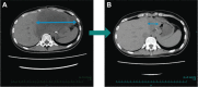 Figure 2. SDH-deficient patient with pathologic PR. A 29-year-old female patient with SDH-deficient GIST diagnosed in 2020 without any prior cancer systemic therapies, demonstrated a maximum 87% decrease in tumor size, following treatment with DS-6157a, at the MTD confirmed dose of 6.4 mg/kg. The target lesion, an abdominal mass, was 150 mm at baseline (A) which decreased to 33 mm in Cycle 3 and decreased further to 20 mm 4 weeks later (B). The patient discontinued from study to undergo a surgical resection of the remaining small lesion to become tumor-free. The resected tumor, showed a pathologic CR per the investigator's assessment.