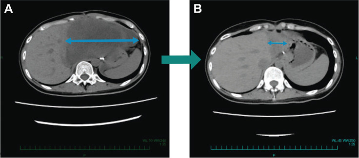 Figure 2. SDH-deficient patient with pathologic PR. A 29-year-old female patient with SDH-deficient GIST diagnosed in 2020 without any prior cancer systemic therapies, demonstrated a maximum 87% decrease in tumor size, following treatment with DS-6157a, at the MTD confirmed dose of 6.4 mg/kg. The target lesion, an abdominal mass, was 150 mm at baseline (A) which decreased to 33 mm in Cycle 3 and decreased further to 20 mm 4 weeks later (B). The patient discontinued from study to undergo a surgical resection of the remaining small lesion to become tumor-free. The resected tumor, showed a pathologic CR per the investigator's assessment.