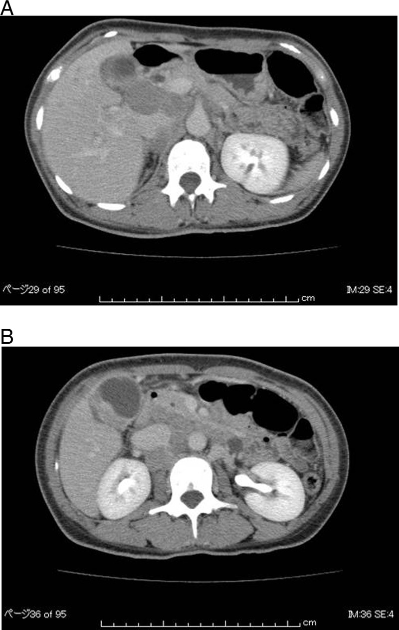 Small Cell Gall Bladder Carcinoma Complicated By Syndrome Of Inappropriate Secretion Of