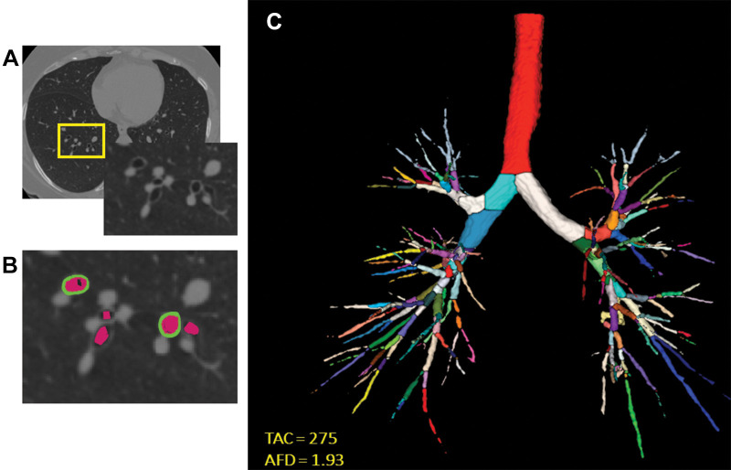 Images show airway metrics. (A) Noncontrast-enhanced axial view chest CT image shows cross sections of segmental airways. (B) Inset shows segmented airway wall (green) and airway lumen (pink). (C) Segmented airway tree with color-coded branches. The resulting total airway count (TAC) and airway fractal dimension (AFD) are shown in C.