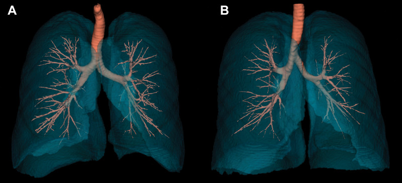 Representative examples of airways in lifetime never-smoker men and women. (A) Noncontrast-enhanced three-dimensional reconstructed chest CT image in a lifetime never-smoker 64-year-old man (height, 1.74 m; total lung capacity, 8.1 L; forced expiratory volume in 1 second [FEV1]-to–forced vital capacity [FVC] ratio, 0.80; and FEV1, 127% predicted) shows airway volume of 57 dL, total airway count of 526, and airway fractal dimension of 1.695. (B) Noncontrast-enhanced three-dimensional reconstructed chest CT image in a lifetime never-smoker 63-year-old woman (height, 1.73 m; total lung capacity, 6.1 L; FEV1-to-FVC ratio, 0.76; and FEV1, 100% predicted) shows airway volume of 34 dL, 299 viewable airway branches, and airway fractal dimension of 1.513.