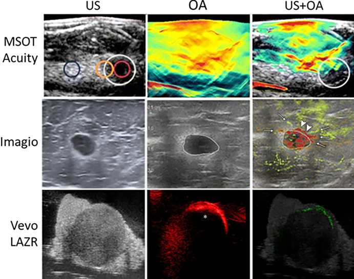 Multispectral optoacoustic tomographic (MSOT) images from different commercially available optoacoustic (OA) medical imaging systems. Images were acquired noninvasively from patients with breast cancer (MSOT Acuity [iThera Medical] and Imagio [Seno Medical]) or from excised lymph nodes in patients with melanoma (Vevo LAZR [VisualSonics]). Each set of images exhibits US imaging, OA imaging, and the overlay of the two modalities. Adapted, with permission, from references 4 (MSOT Acuity), 9 (Imagio), and 10 (Vevo LAZR).