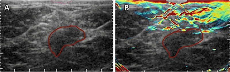 A, Anatomic US image and B, hybrid optoacoustic and US images of a grade 3 invasive ductal carcinoma. Hybrid imaging allowed visualization of the irregular cap of neoangiogenesis in relation to the hypoechoic irregular tumor mass. The tumor margin is outlined in red.