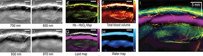 A–D, Multispectral optoacoustic tomographic (MSOT) images of human breast reconstructed online using a delay-and-sum method. E–H, The same MSOT images reconstructed offline using a model-based method followed by linear unmixing. I, Merged image of all four absorbers unmixed and visualized in images E–H. Adapted, with permission, from reference 8. Hb = deoxyhemoglobin, HbO2 = oxyhemoglobin.