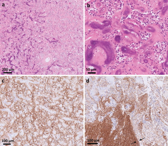 Histological slides of the EWSR1::PATZ1 gene fusion CNS tumor