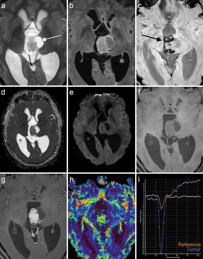 MRI images of the EWSR1::PATZ1 gene fusion CNS tumor