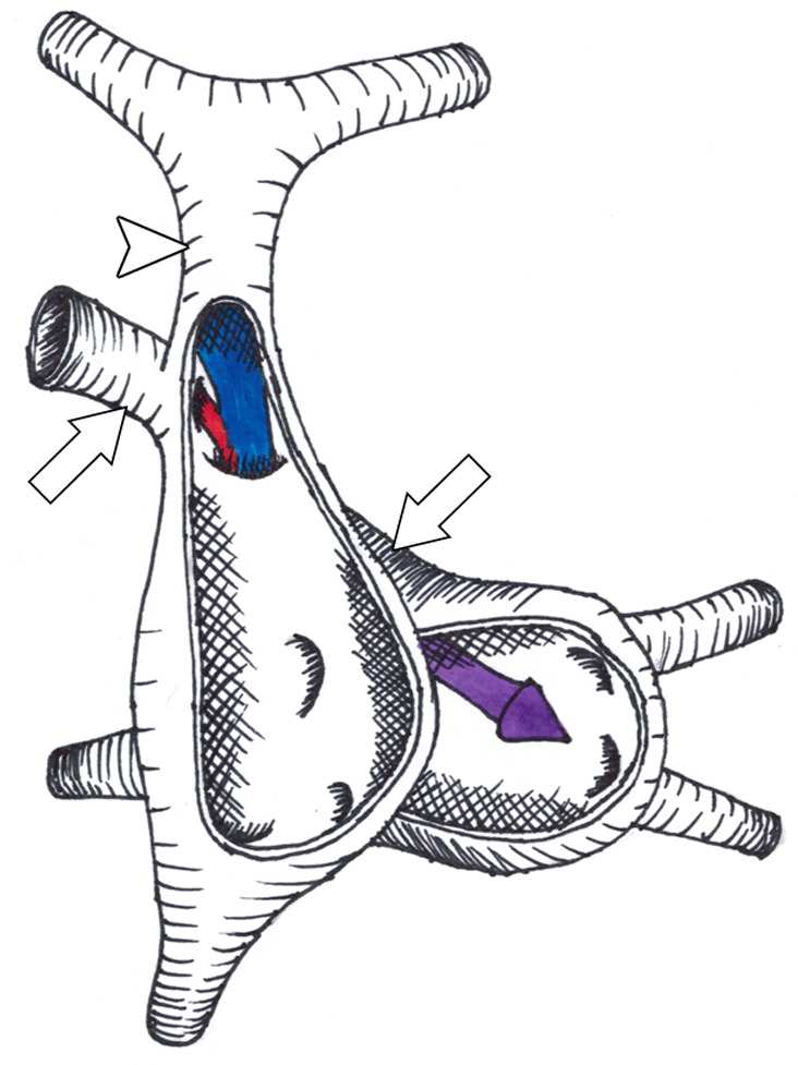 (a,b) Diagrams of the defect between the right superior vena cava (SVC, arrowhead) and the right upper pulmonary vein (arrows). The right upper pulmonary vein continues its normal course and connects to the left atrium. Anterior walls of the right and left atria are removed, showing the intact true atrial septum. Mechanism of left-to-right shunt is shown in (a) with pulmonary venous return from the left atrium flowing retrograde through the right upper pulmonary vein (red arrow), through the defect, and into the right atrium. Pulmonary venous return from the right upper pulmonary vein is also shown joining the red arrow going into the right atrium. (b) Stenosis of the SVC orifice to the right atrium leads to a predominantly right-to-left shunt. In this case, systemic venous return from the right SVC flows through the defect (blue arrow) and into the right upper pulmonary vein, joining pulmonary venous return from the right upper pulmonary vein (red arrow) and shunting into the left atrium (purple arrow).