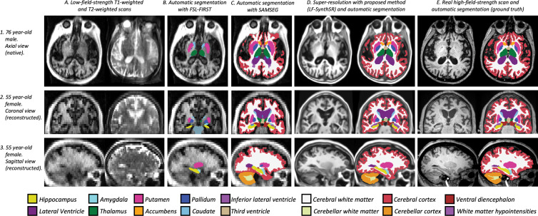 Qualitative comparison of the proposed method (LF-SynthSR) with automated segmentation tools in three different participants; image sections are shown in both native (axial) and orthogonal reconstructed projections (coronal, sagittal). Row 1 shows an axial section (native), row 2 shows a coronal section (reconstructed), and row 3 shows a sagittal section (also reconstructed). The images show (A) low-field-strength T1-weighted and T2-weighted MRI scans, automated segmentations produced by (B) FSL-FIRST (6) and (C) SAMSEG (12), (D) the output of LF-SynthSR and its automated segmentation with SynthSeg (13,14), and (E) registered real high-field-strength scan and its automated segmentation with SynthSeg.