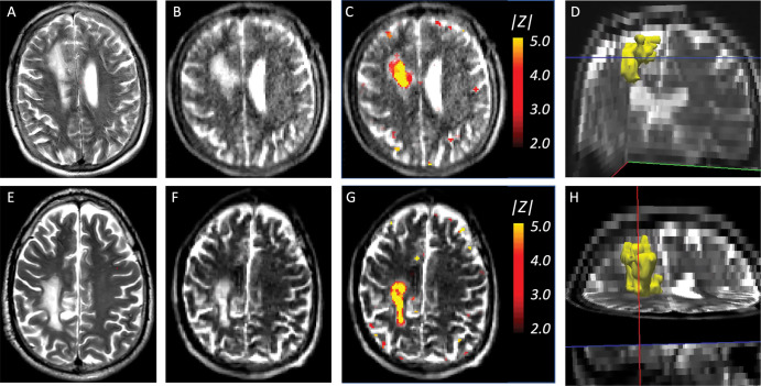 Stroke lesions and abnormality maps for the two participants with stroke in the test set that satisfied the inclusion criteria. (A) Axial section of a T2-weighted high-field-strength (3-T) MRI scan in a 51-year-old male participant, without contrast ehnancement, shows a stroke lesion. (B) Approximately corresponding section in a T2-weighted low-field-strength (0.064-T) MRI scan in the same participant. (C) Abnormality map (ie, absolute value of Z scores) for the same section, thresholded at |z| = 1.96 (ie, the 95% CI), overlaid on the low-field-strength scan. (D) Three-dimensional rendering of the main cluster of the abnormality map, shows the whole stroke lesion. (E) Coronal section in a 63-year-old female participant, acquired with the same imaging protocol as A, also with a stroke lesion. (F) Approximately corresponding section in low-field-strength scan. (G) Abnormality map thresholded at the 95% CI. (H) Three-dimensional rendering.