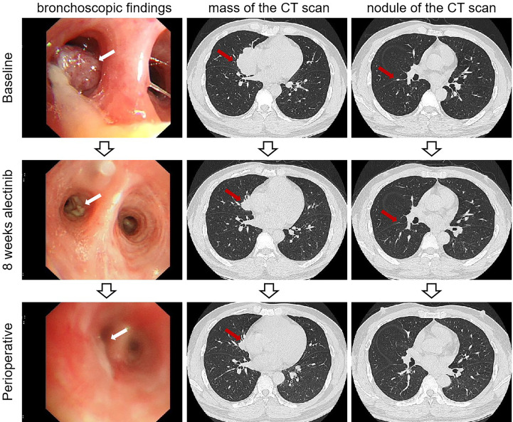 Pathological complete response to long-course neoadjuvant alectinib in ...