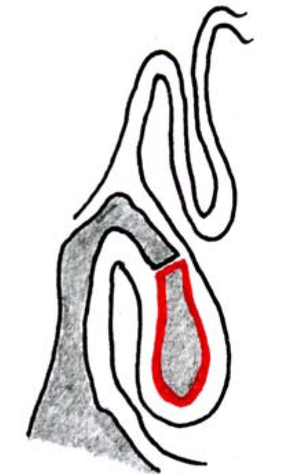 Surgery of the turbinates and “empty nose” syndrome - PMC