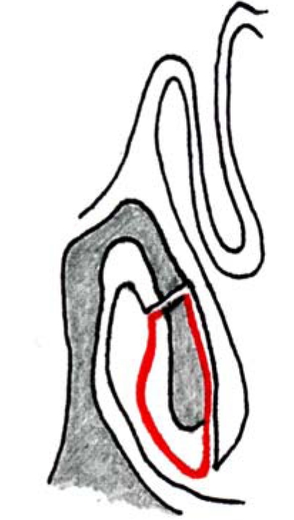 Surgery of the turbinates and “empty nose” syndrome - PMC