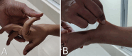 Clinical images of an 8-year-old male patient with autosomal recessive cutis
laxa show (A) joint hyperextensibility and (B) skin laxity.