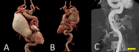Volume-rendered CT images in the patient show (A) an ascending aortic aneurysm
with (B) severe tortuosity of the descending aorta. (C) Coronal maximum intensity
projection image shows severe tortuosity and corkscrew appearance of the branches of
the superior mesenteric artery (yellow arrow).