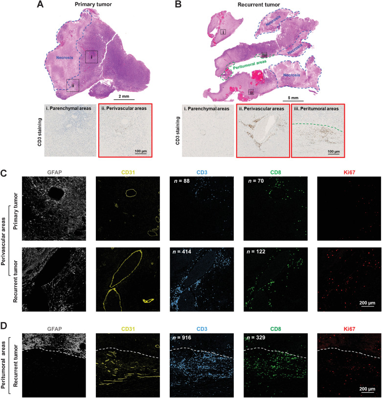 Figure 2. Increased T lymphocyte infiltration in the recurrent compared with the primary tumor. H&E and CD3 IHC staining in the primary (A) and recurrent tumor (B). The regions that are selected to show the CD3 IHC staining are indicated in the H&E-stained tissue sections. Expressions of GFAP (GBM cells), CD31 (vascular epithelial cells), CD3 (T lymphocytes), CD8 (CD8+ T cells), and Ki67 (proliferating marker) in the perivascular areas of primary and recurrent tumor (C) and peritumoral areas of the recurrent tumor (D) were detected by IMC. Scale bars are indicated in the figures.