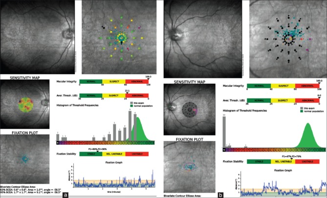 Melanoma associated retinopathy - OJO 8 125 G002