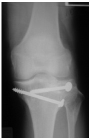 Fig. 2b: Final position after healing.