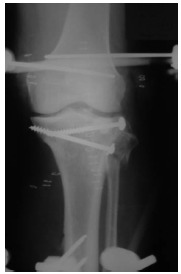 Fig. 2a: Anteroposterior radiographic
view of bicondylar plateau fracture after transarticular external fixation and limited internal fixation.