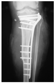 Fig. 1: Position after internal fixation
with Less Invasive Stabilization System (LISS) plate.