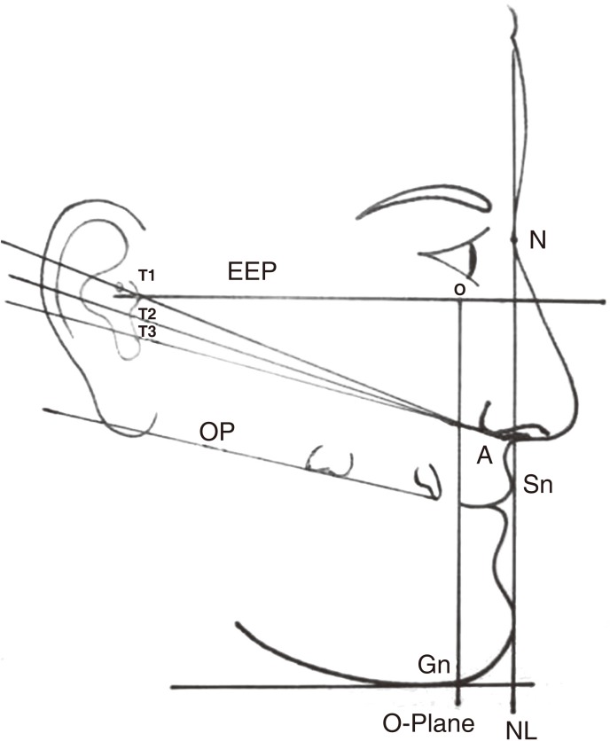 A determination of occlusal plane comparing different levels of the ...