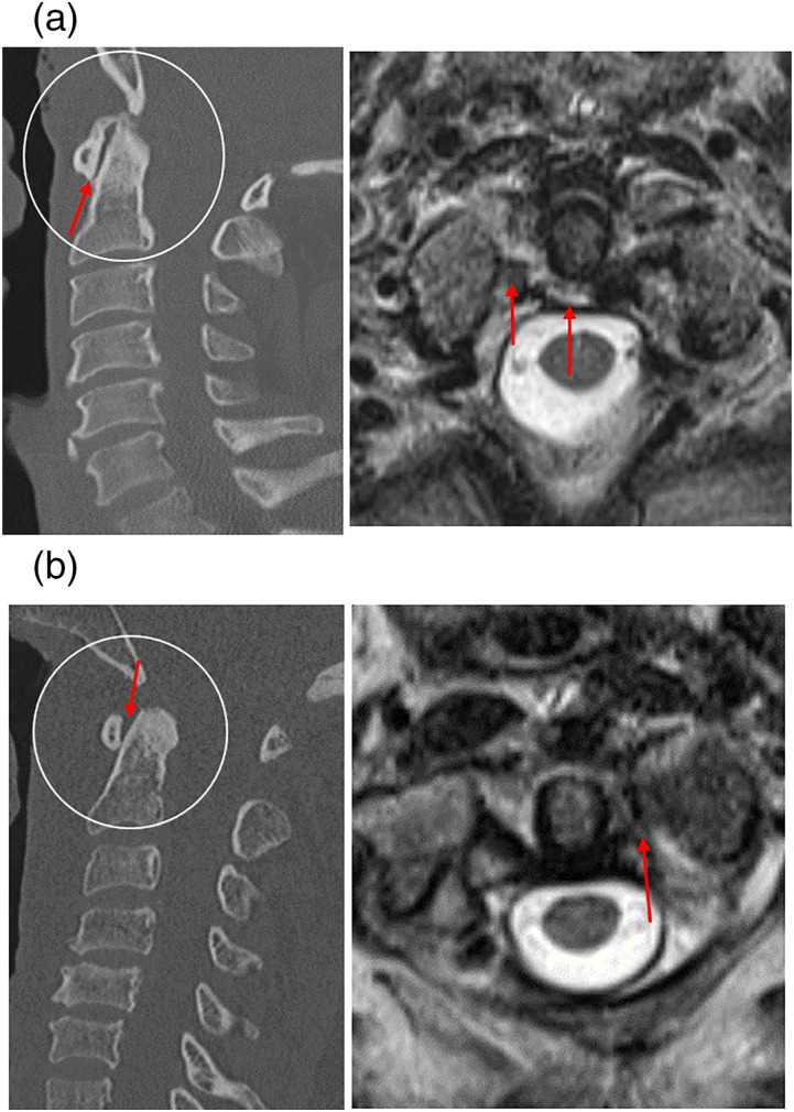 Utility of Anterior Atlantodens Interval Widening on Cervical Spine CT ...