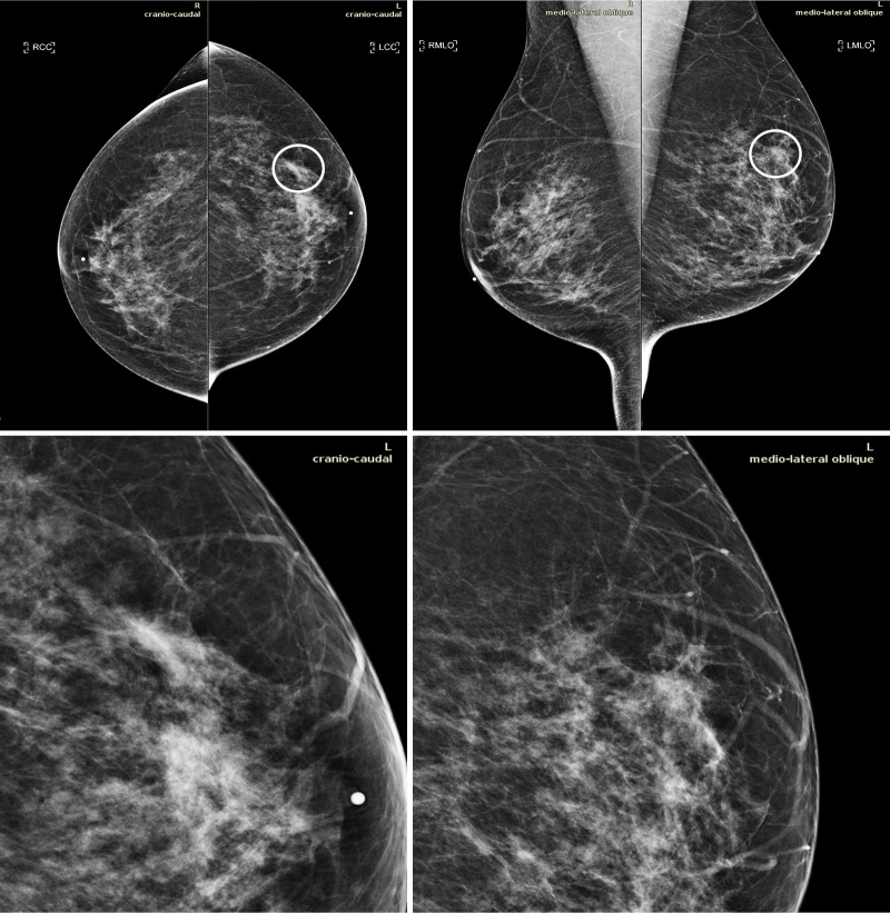 Mammograms in a 51-year-old woman with invasive ductal carcinoma. The upper panels show the craniocaudal and the mediolateral oblique views. The lower panels show a close-up of the left breast area containing the lesion. The case is one of the false-negative cases included in the dataset. Accordingly, the initial screening assessment was a BI-RADS 2, meaning visible findings were judged as benign. After 1 year, the patient presented for another screening examination. This time, a focal asymmetry with associated distortion within the left breast was noticed; the patient was recalled and diagnosed with a 1.5-cm mass in the upper outer quadrant of the left breast on the craniocaudal view (circle).