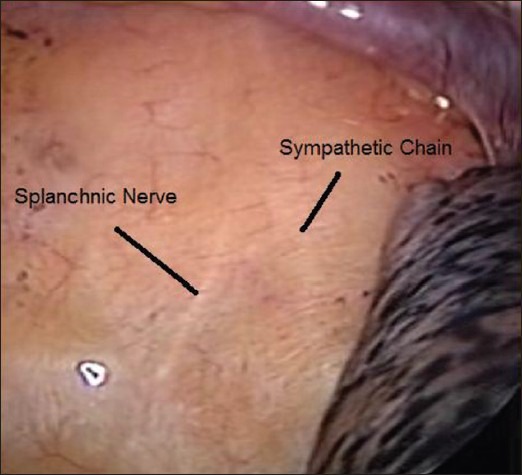 Thoracoscopic splanchnicectomy as a palliative procedure for pain ...