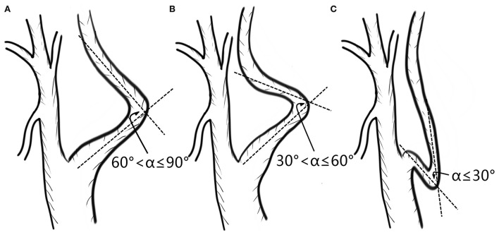 Association between kinking of the cervical carotid or vertebral artery ...