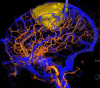 Image shows recurrent superior falcine meningioma with MRI tumor
segmentation and image fusion with cone-beam CT digital subtraction
angiography and cone-beam CT diameter spherical volume for preoperative
mapping and assessment of the eloquence of venous structures. Occlusions of
the sagittal sinus and middle meningeal tumor supply are
depicted.